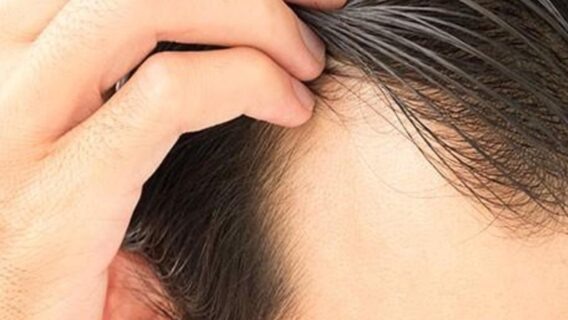 Fim da Calvície: Descubra as Causas e Tratamento