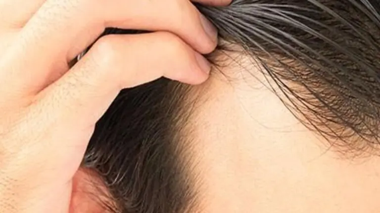 Fim da Calvície: Descubra as Causas e Tratamento