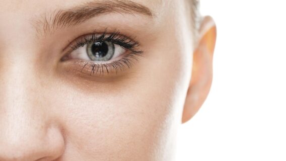 5 dicas e tratamentos para diminuir as olheiras