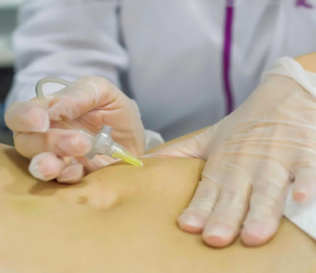 como funciona a carboxiterapia