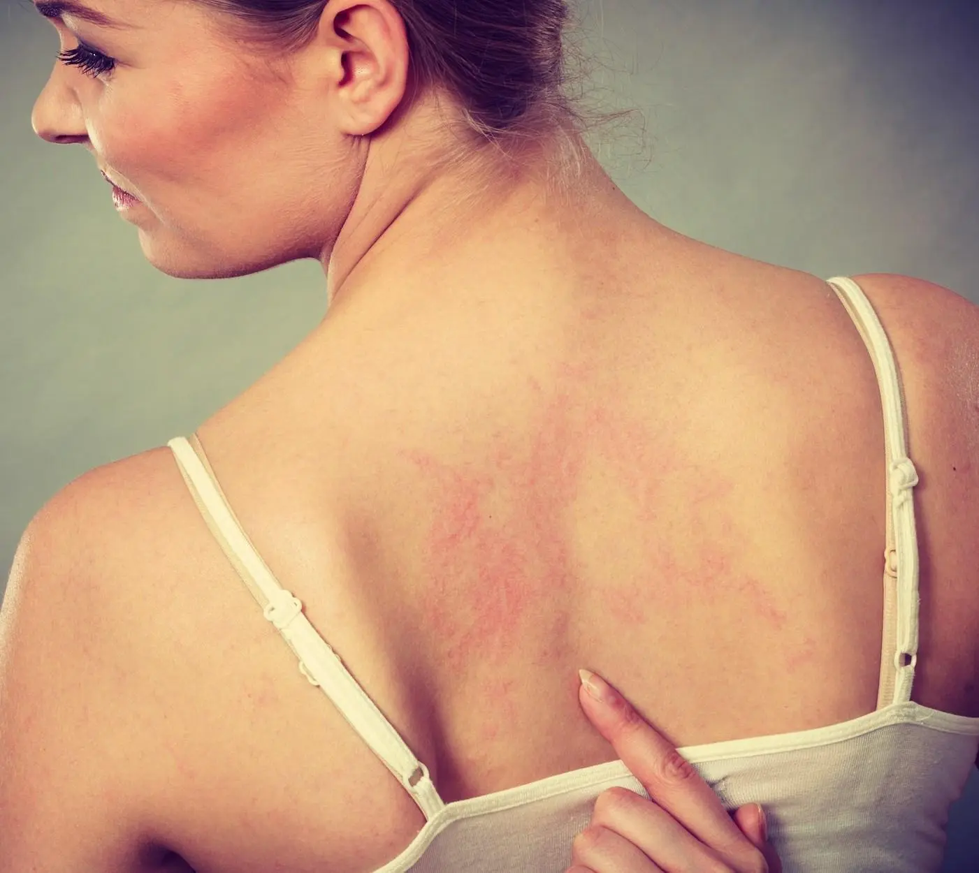 sintomas herpes-zoster herpes-zoster