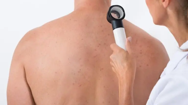 Herpes Zóster: entenda o que é, sintomas e como tratar