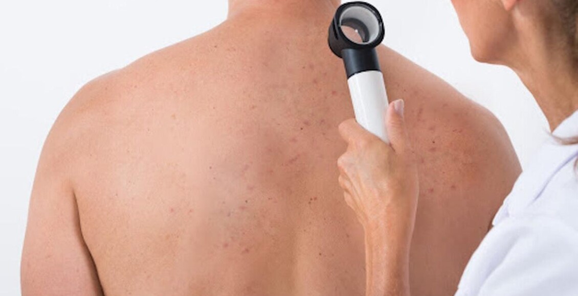 herpes zoster