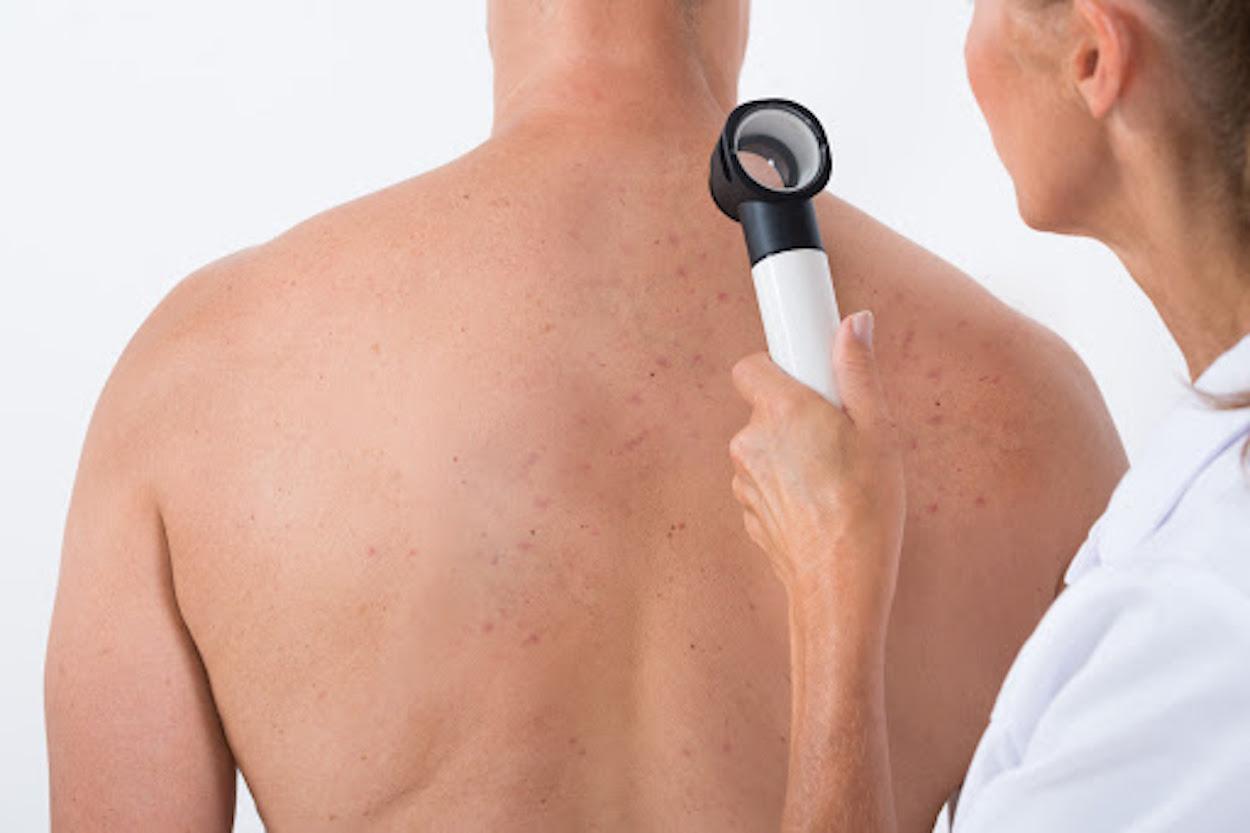 herpes zoster