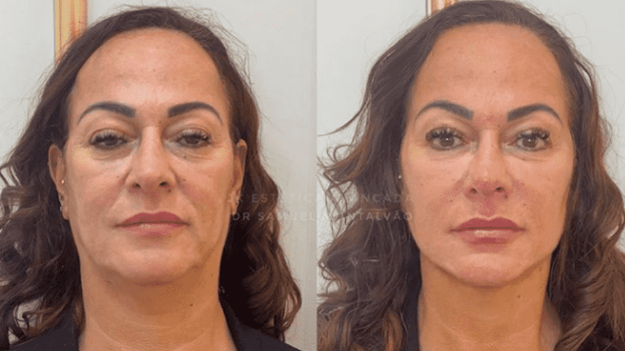 Nadine goncalves antes e depois de harmonizacao facial