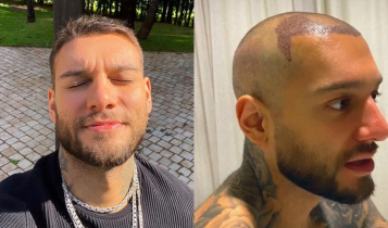 6 famosos que fizeram transplante capilar; Veja resultado