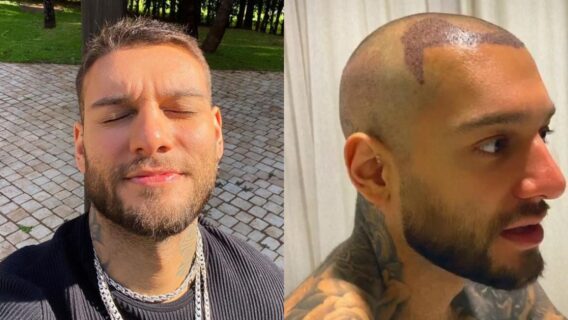 6 famosos que fizeram transplante capilar; Veja resultado