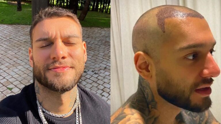 6 famosos que fizeram transplante capilar; Veja resultado