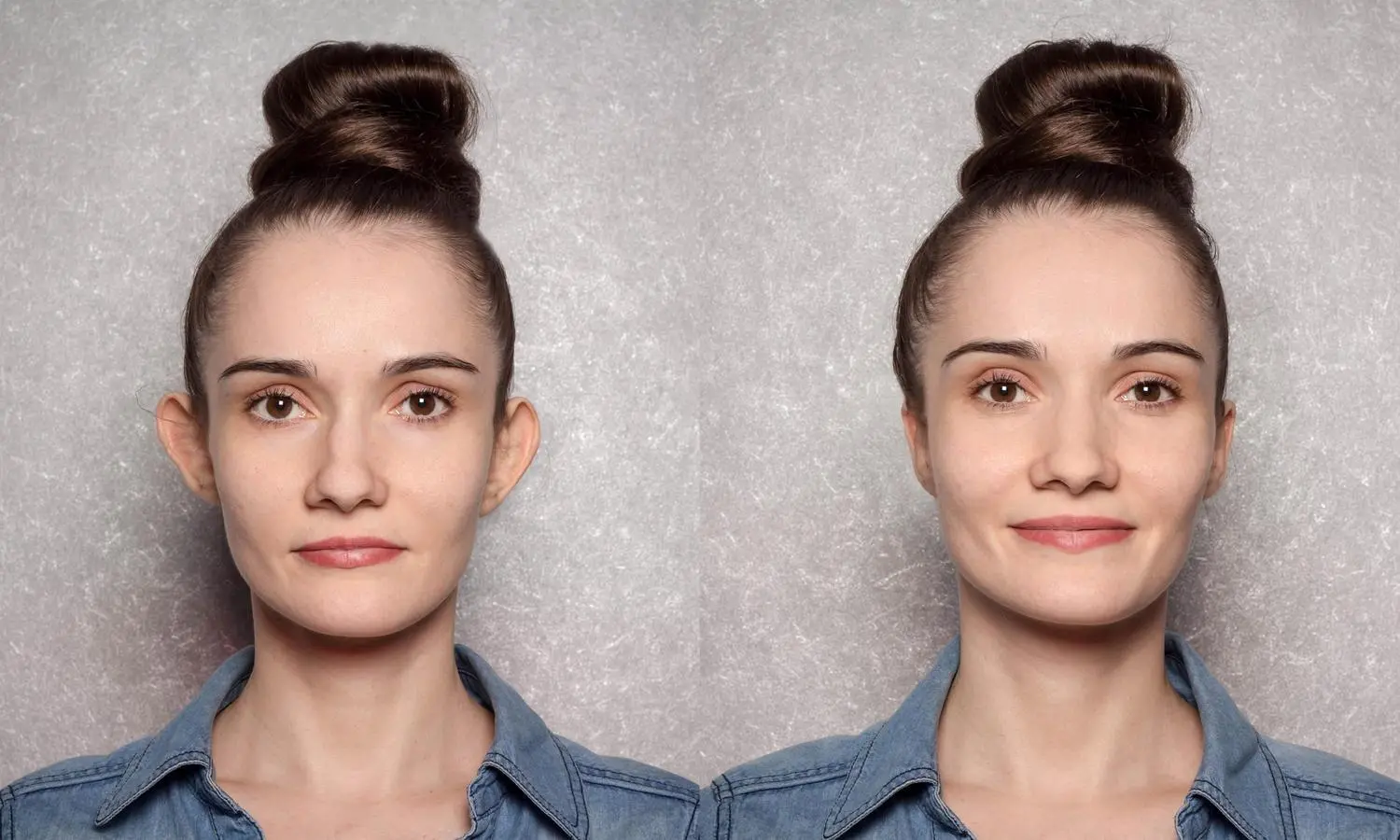 A otoplastia é uma das cirurgias plásticas cobertas pelo SUS