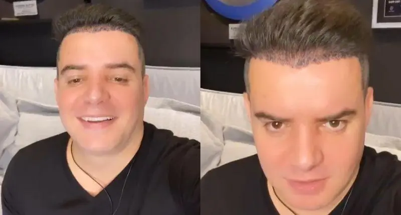 Famosos que fizeram transplante capilar