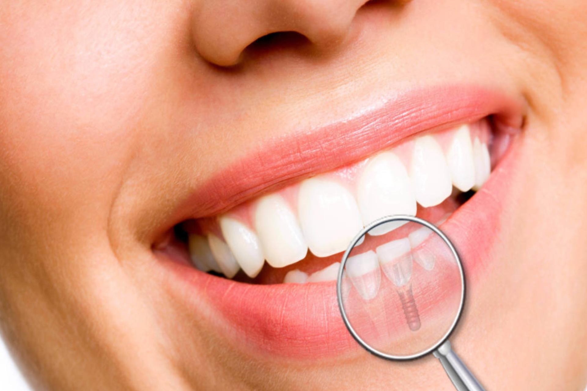 Como conseguir um implante dentário pelo sus