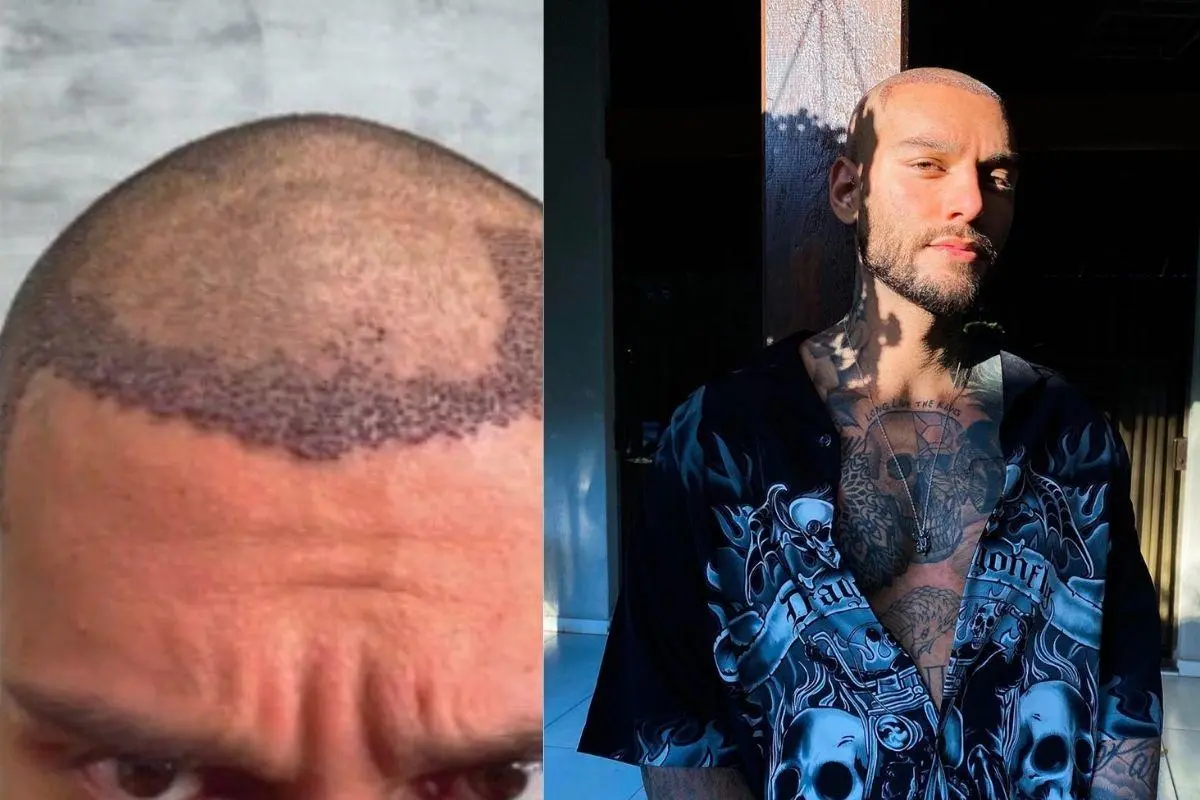 Lucas Lucco e Famosos que fizeram transplante capilar