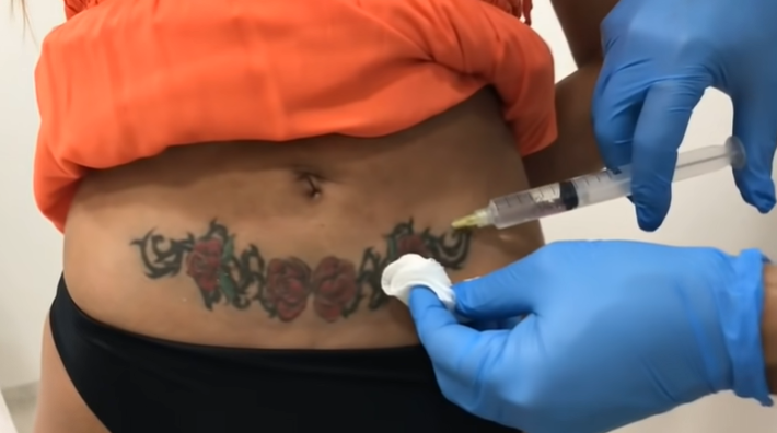 Imagem mostra andressa urach tomando anestesia para tirar tatuagem na barriga