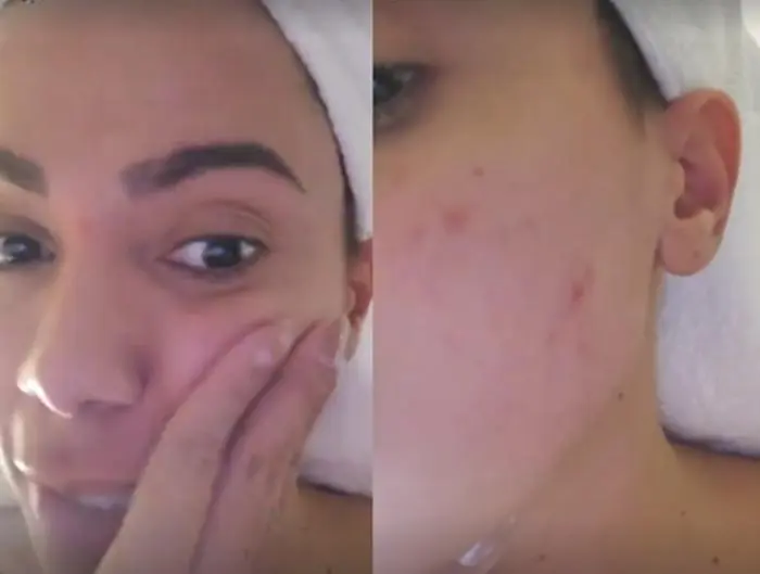 Na imagem Anitta mostra pele com espinhas