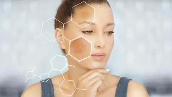 Melasma: aprenda o que fazer para prevenir e tratar o problema 