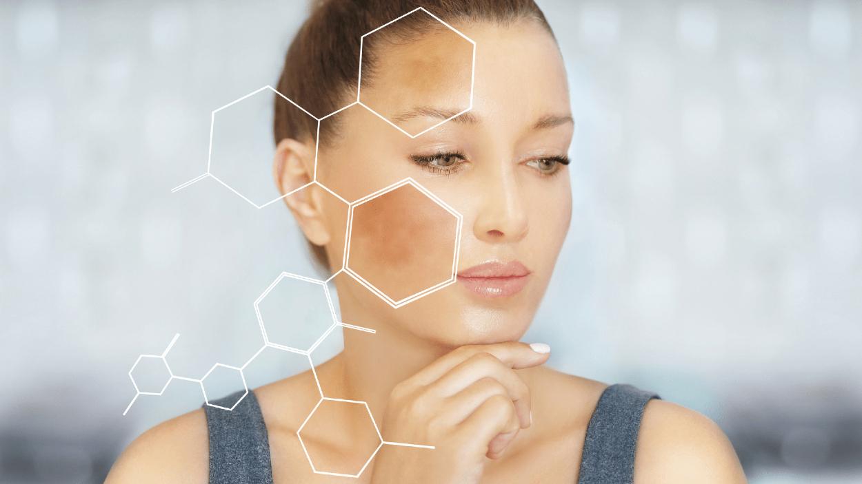 melasma