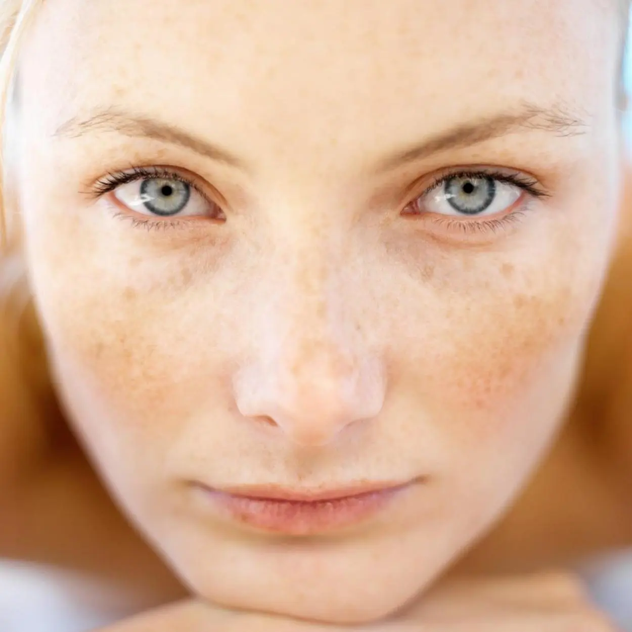 melasma