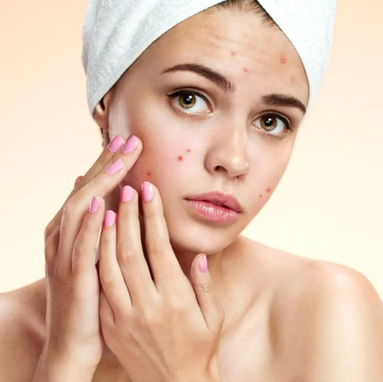 pele com acne