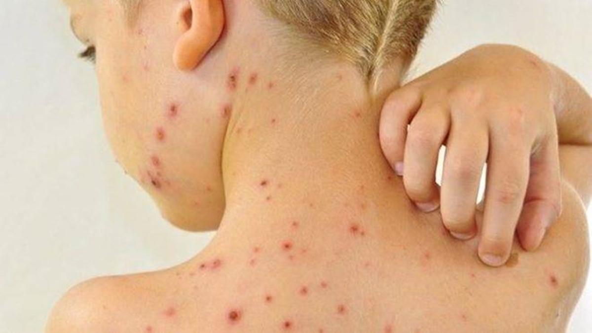 Sarampo: aumento de casos e alerta para vacinação