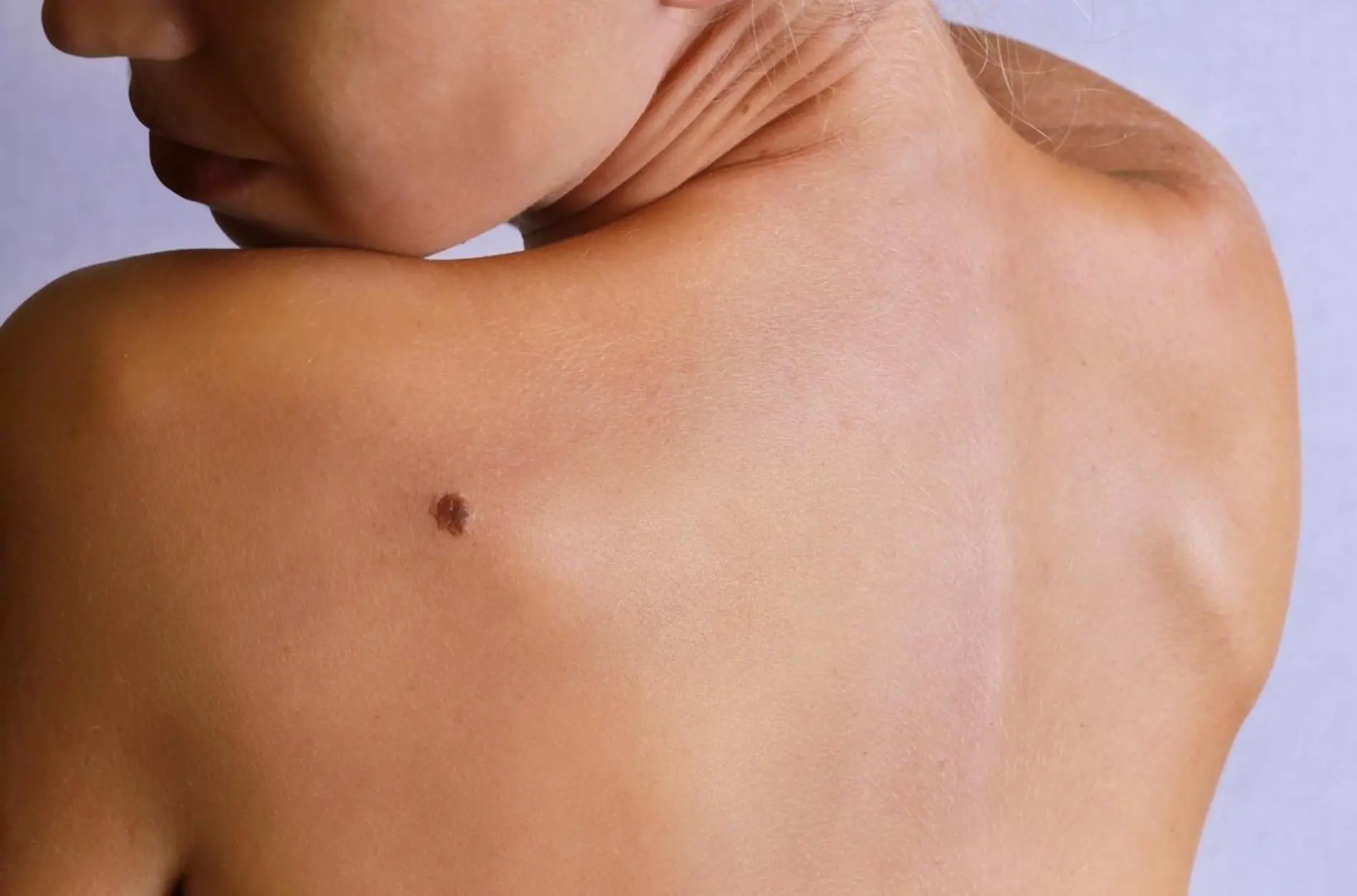 pintas podem ser sinal de câncer