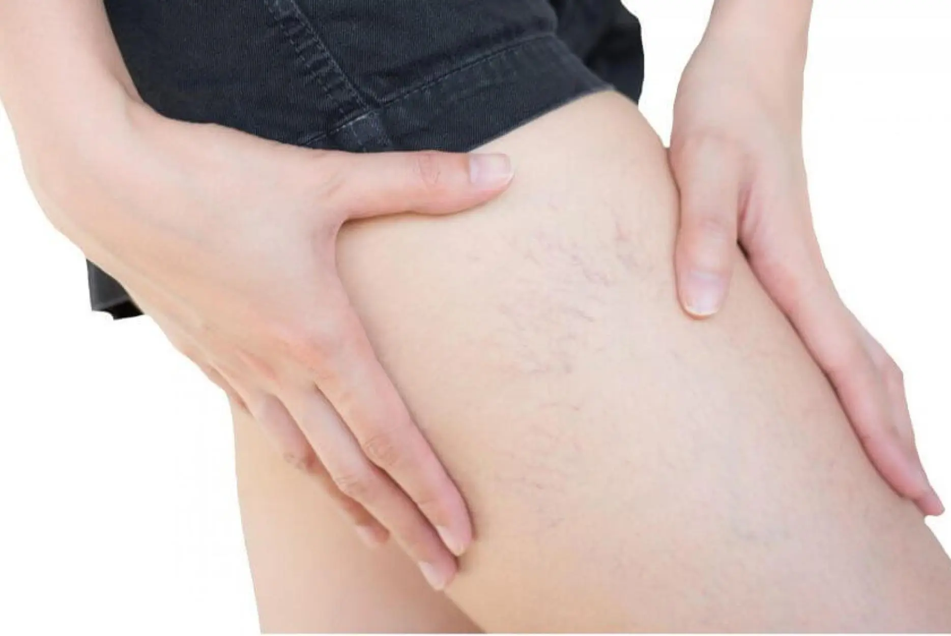 vasinhos nas pernas vasinhos nas pernas