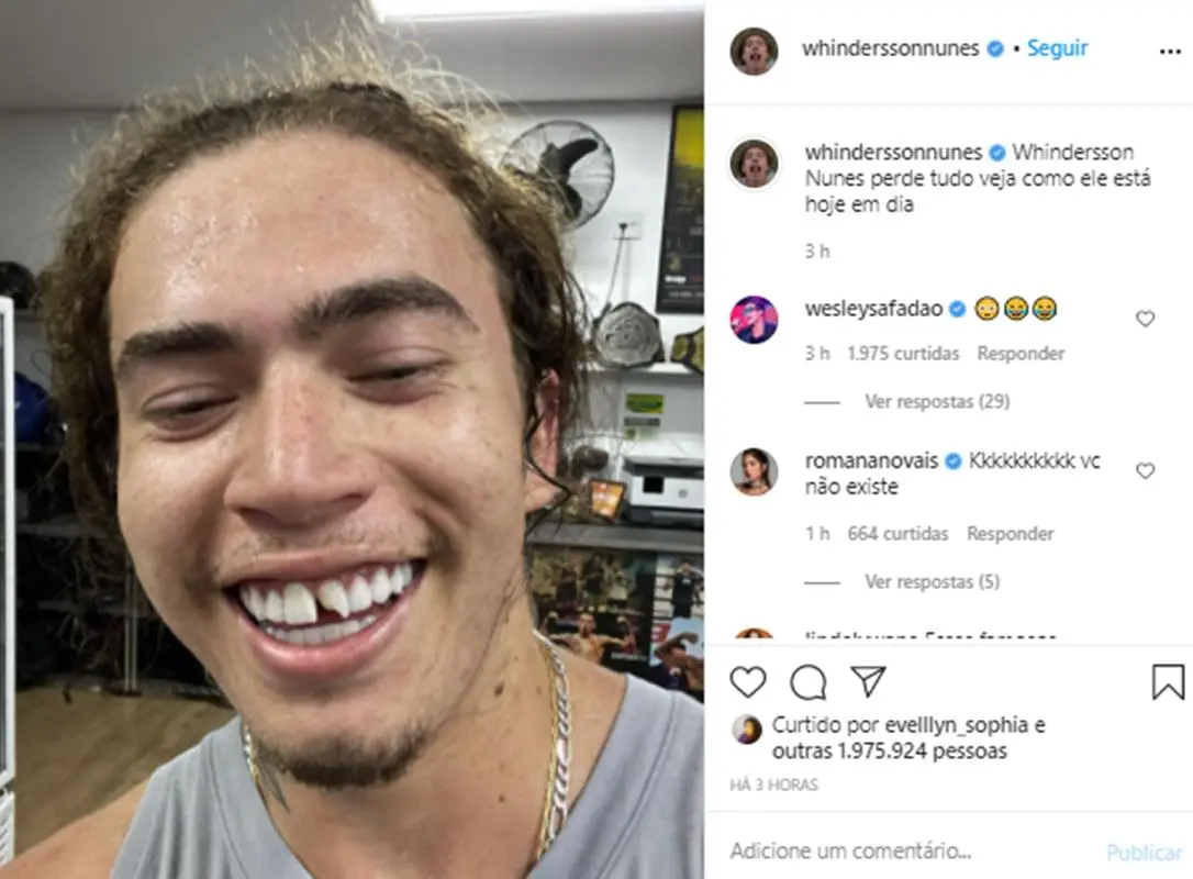 Na imagem Whindersson Nunes com dente quebrado
