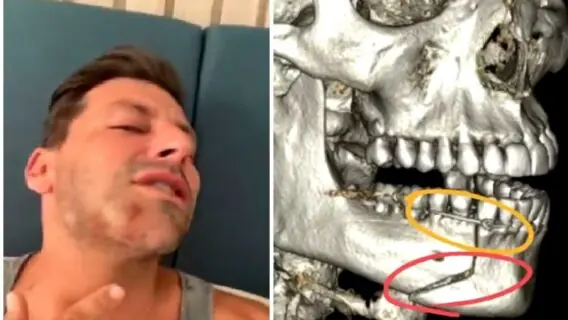 Henri Castelli é agredido e fratura mandíbula; entenda o que aconteceu