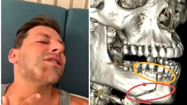 Henri Castelli é agredido e fratura mandíbula; entenda o que aconteceu