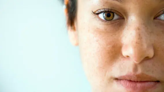 Pele com melasma: dicas para se cuidar no verão