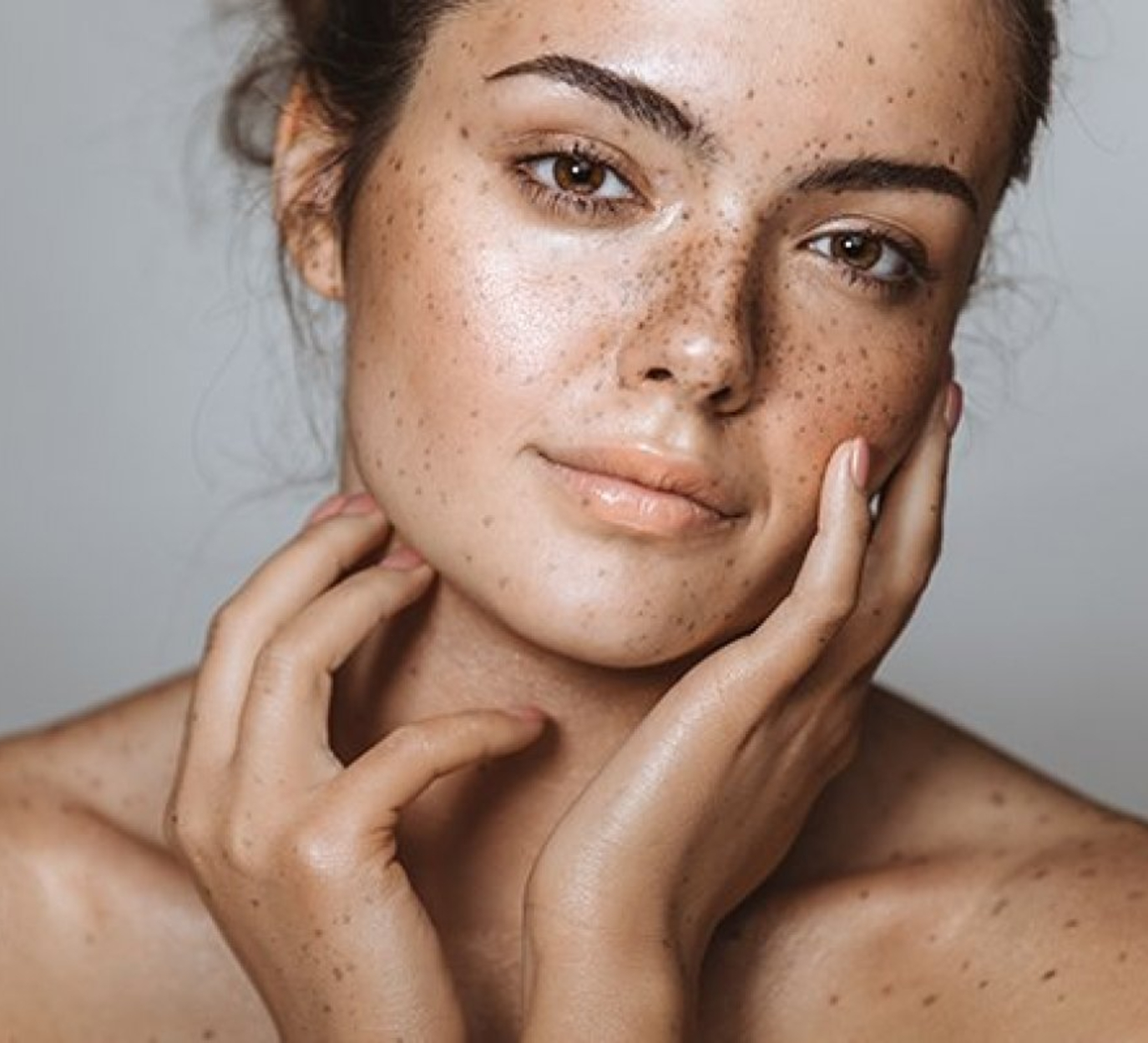 pele com melasma pele com melasma