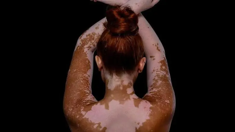 Pele livre: melhores influenciadoras do movimento Skin Positivity