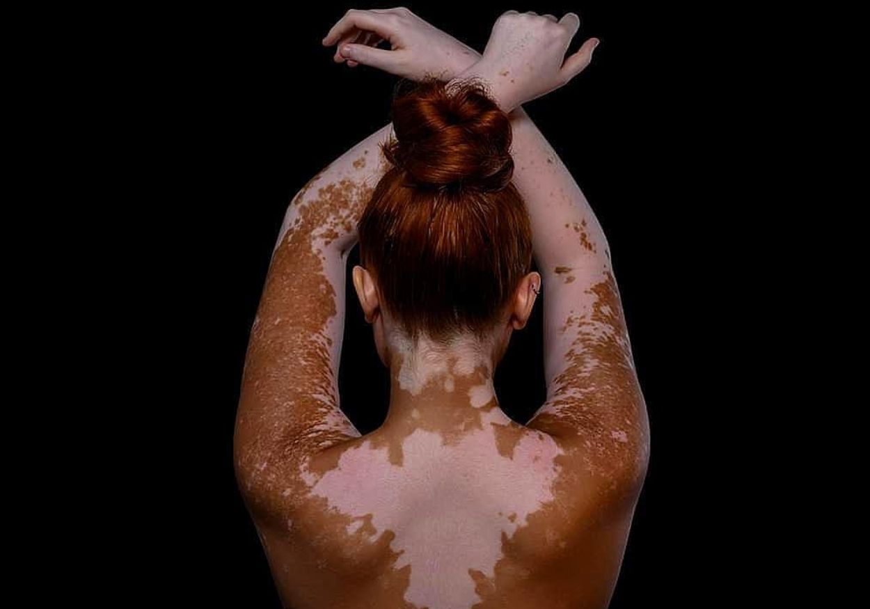 Pele livre: melhores influenciadoras do movimento Skin Positivity
