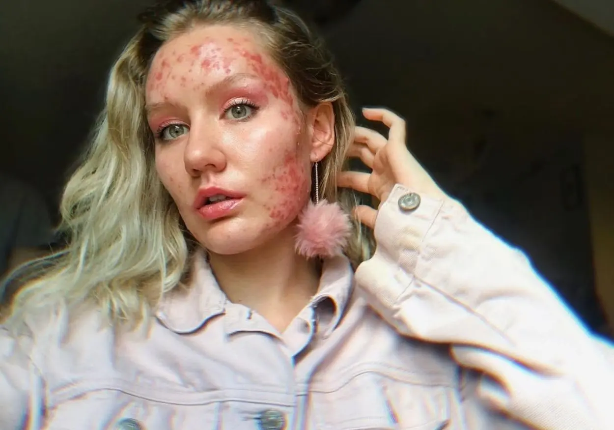 Pele livre: melhores influenciadoras do movimento Skin Positivity