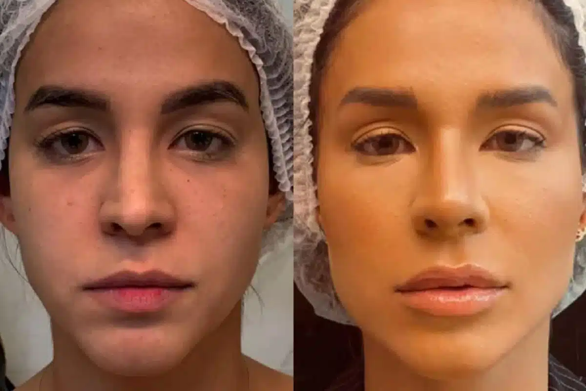 kerline antes e depois