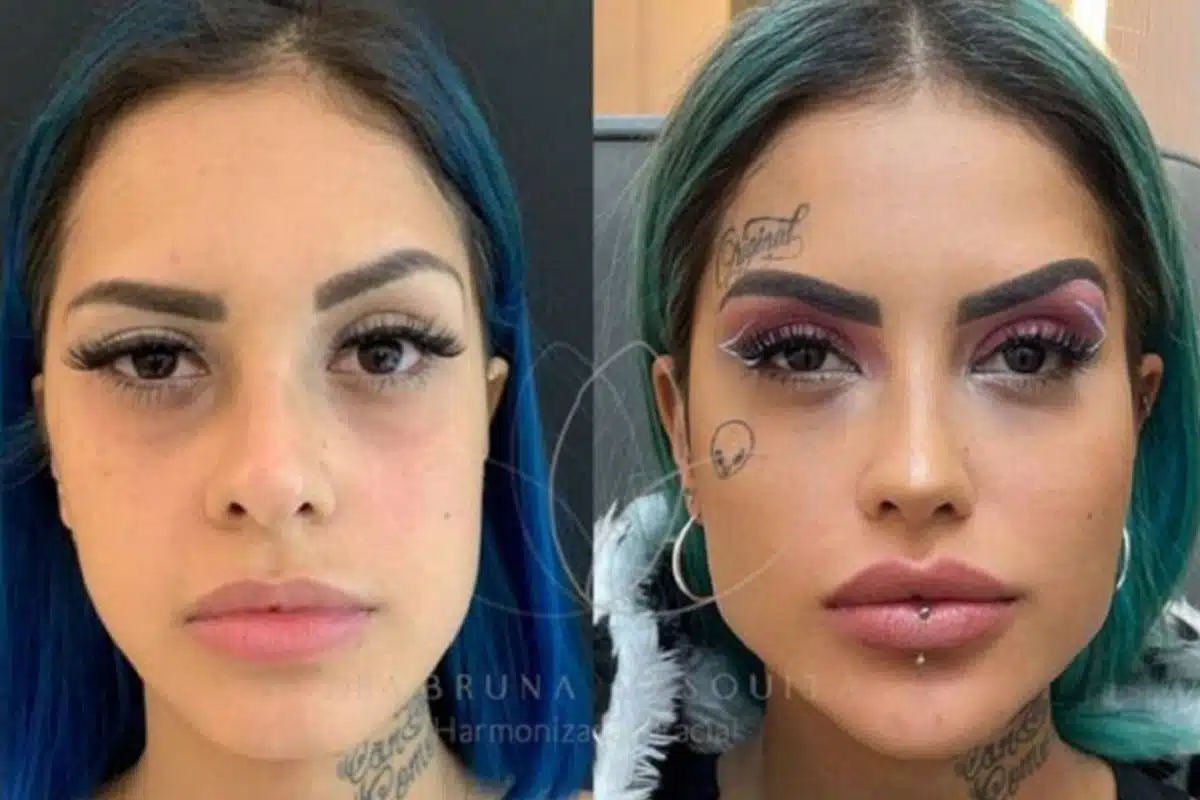 antes e depois