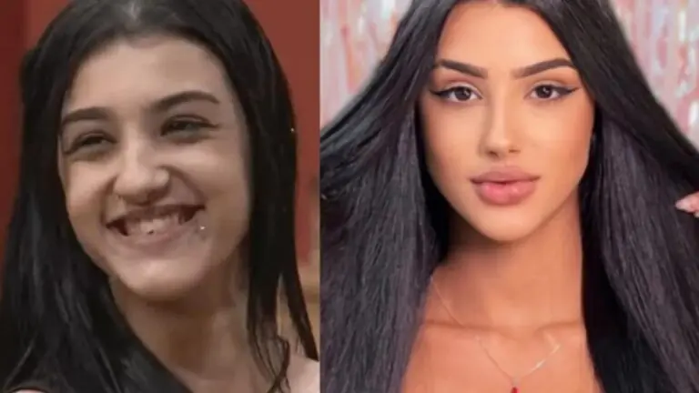 Veja o antes e depois de Bia Miranda antes após procedimentos estéticos