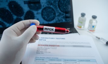 doença Mpox